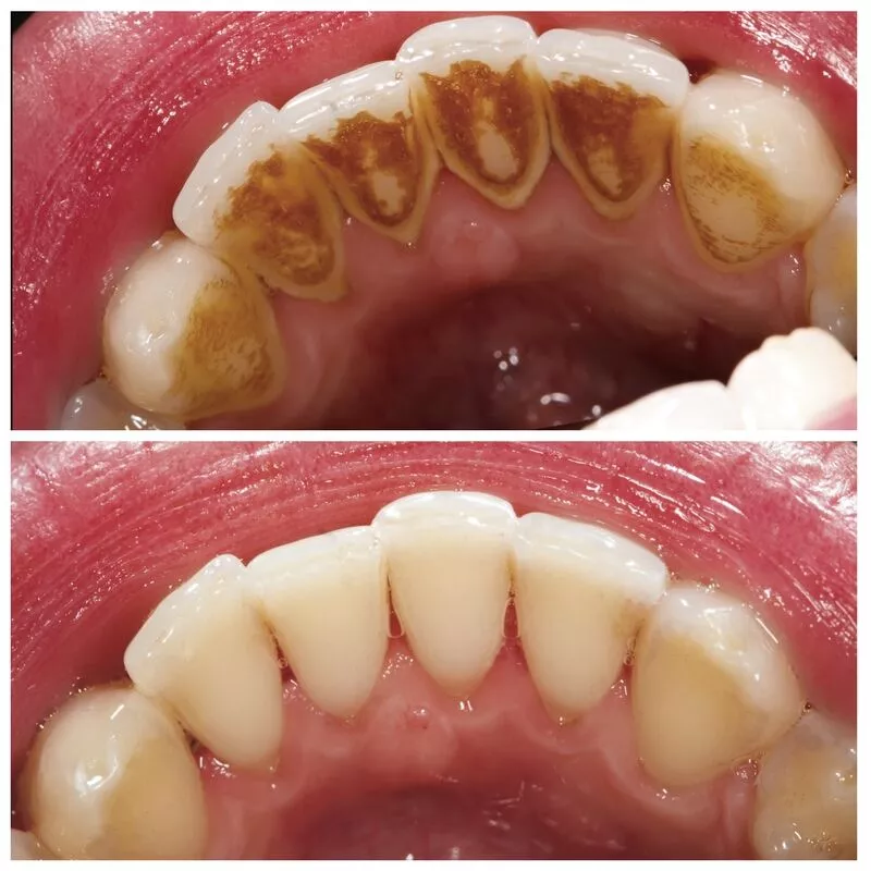 Rushikesh Chavan Before and After Treatment