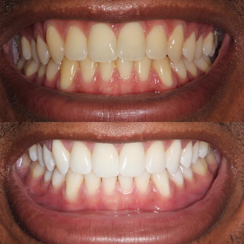 Rajnish Baria Before and After Treatment